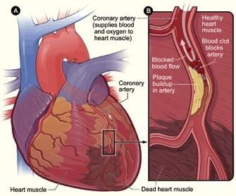 Acute Coronary Syndrome Diagnosis